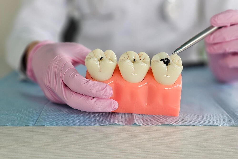 Dental Fillings
